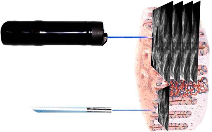 Jong Wook Kim, et al:molecular Imaging of Gastrointestinal Malignancies 한결과, 이펩티드가이형성 (dysplasia) 이있는부위에는부착하지만, 과형성 (hyperplasia) 부위에는부착하지않음을보였다.