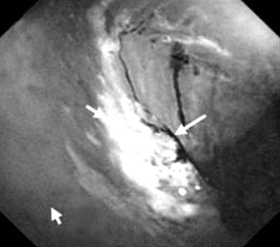 Jong Wook Kim, et al:molecular Imaging of Gastrointestinal Malignancies Fig. 5. Targeted endoscopic imaging using wide-area endoscopy.