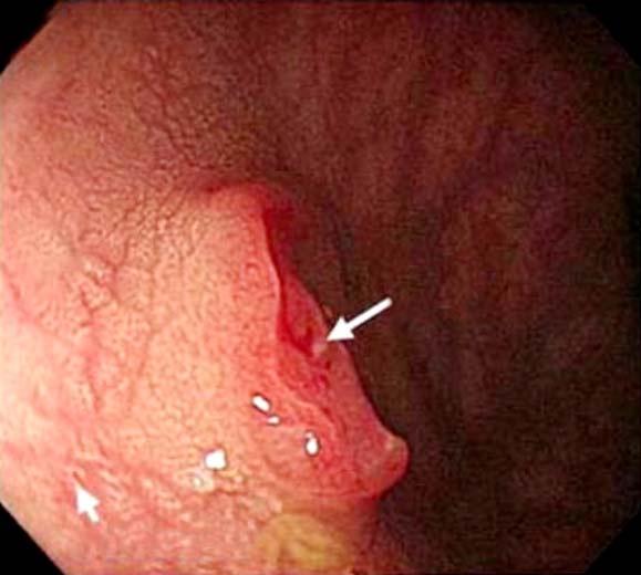 Targeted imaging of flat and depressed colonic neoplasms. Gastrointest Endosc Clin N Am 2010;20:579-583; with permission). 22 평 / 함몰성대장선종, 궤양성대장염, 악성및양성담도협착등의조기진단및감별진단에큰도움이될것으로기대된다.