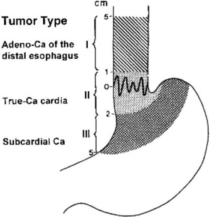 제 14 차 Consensus Conference: Gastric Cancer Fig. 1. Classification of esophagogastric tumors according to Siewert: Type I, esophageal; type II, cardiac; type III, subcardiac.