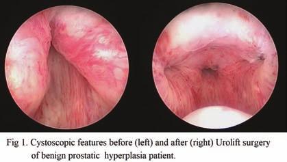 O-204 Urolift: 전립선비대증치료를위한최소침습 intra-prostatic implant - 국내파일럿연구 정현철, 성재우, 양종협, 조신제, 최세웅, 배웅진, 김수진, 조혁진, 하유신, 홍성후, 이지열, 김세웅 가톨릭대학교서울성모병원 Purposes: As a minimal invasive device for benign prostatic