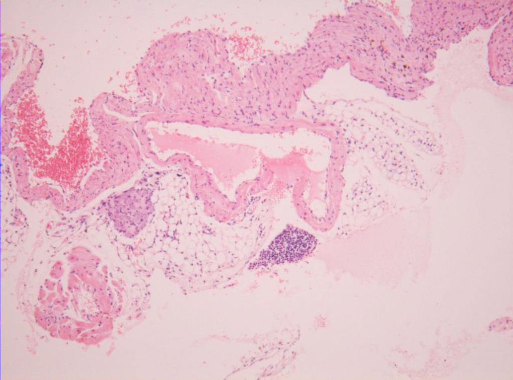 Pediatr Infect Vaccine Vol.24, No.2, 2017 PEDIATRIC Atrium CA Fig. 2. Histologic findings (H&E stain) of the heart are shown ( 200).