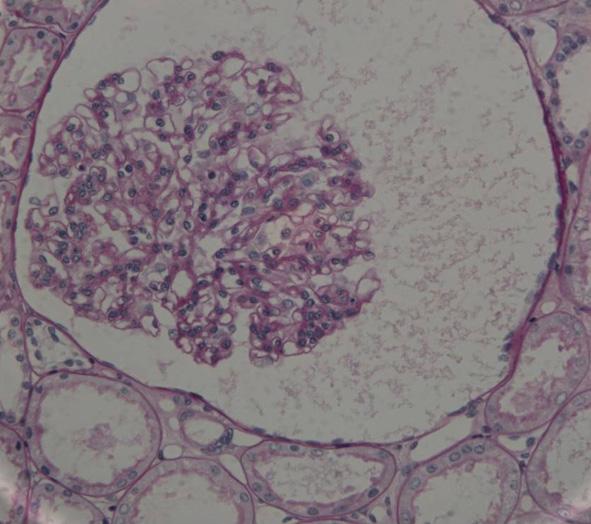 - 김민수외 6 인. 비만과연관된사구체병증 2 예 - A B C Figure 3. The glomerular diameter measured 226~270 µm.
