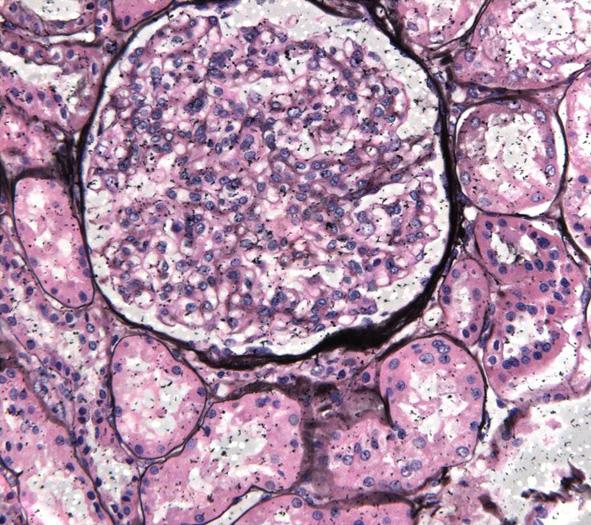 Focal sclerotic mesangium and focal foot process effacement were noted (C: EM stain, 2,500).