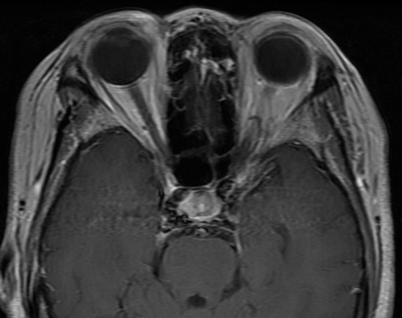 2) 11, 시신경초 (optic nerve sheath) 에서유래하는수막종 (meningioma) 도감별하여야한다.