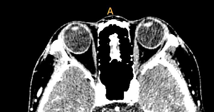 신경안과학과신경이과학에서영상의역할 Figure 4. Orbital CT (left), and fat saturated MR (right) axial images. Thickened left medial rectus is noted in the patient with restricted ophthalmoplegia.