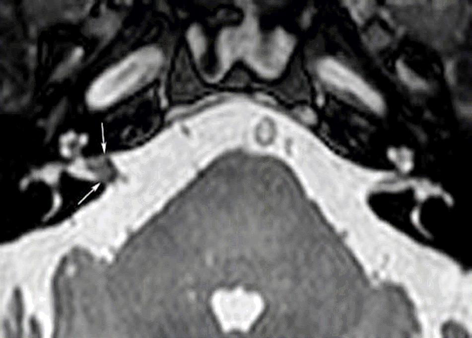 prepontine cistern; (10) fourth ventricle; (11) middle cerebellar pedicle; (12) flocculus; (13) petrous segment of the internal carotid artery; (14) nervus abducens; (15) anterior inferior cerebellar