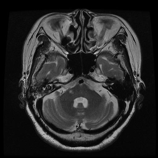 신경안과학과신경이과학에서영상의역할 Figure 7. Axial T2 and diffusion weighted MR images of the 76year-old female patient presented with acute isolated vertigo and hearing difficulty.