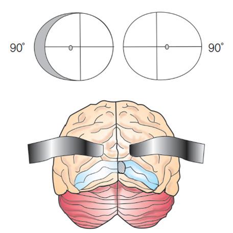 시각계의기능해부 Figure 10. Retinotopic pattern of the optic radiation. Figure 11. Temporal crescent syndrome. 분사이의중앙에위치하고후두엽의후극에투사된다.