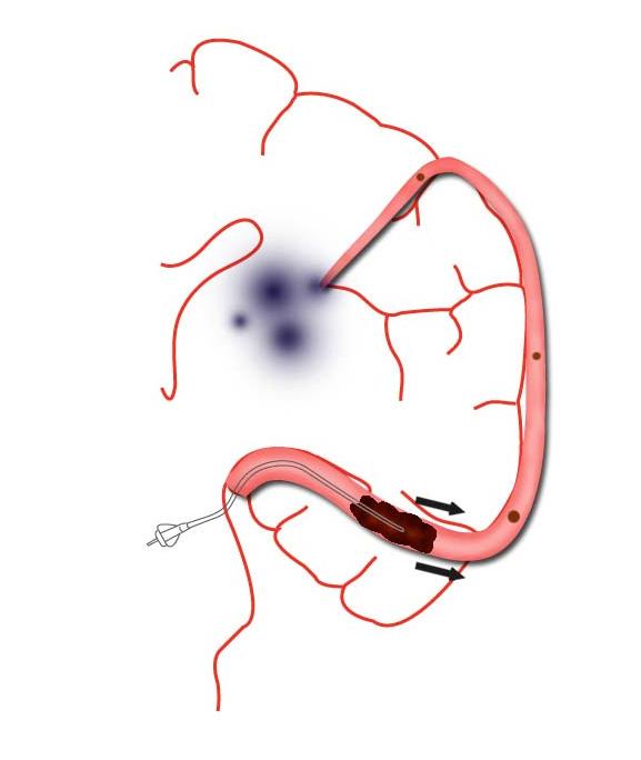 급성뇌경색환자에서동맥내치료의진보 A B Figure 1. Comparison of intra arterial fibrinolysis and mechanical thrombectomy for acute middle cerebral artery occlusion.