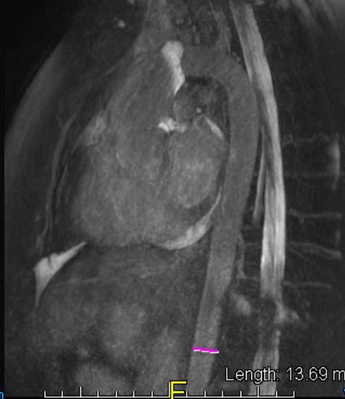 (D) Proximal ascending aorta 의위치다.