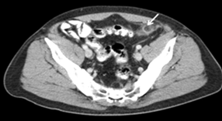 An ovoid fat attenuated mass with hyperattenuated ring (arrow) adjacent to the descending colon on the anti-mesenteric side is noted.