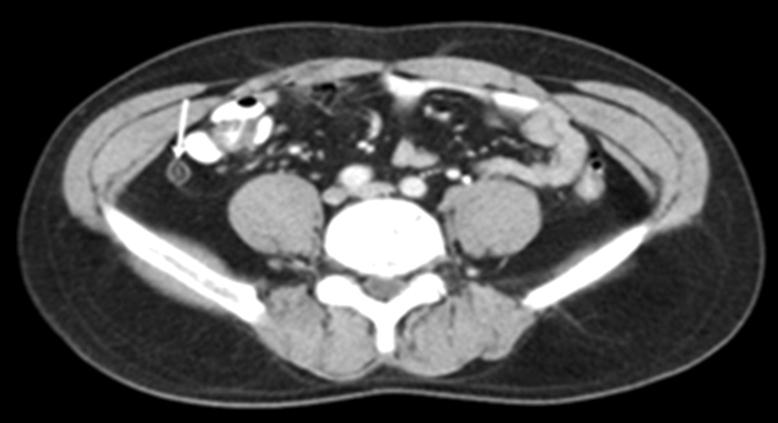 Fatty mass with hyperattenuated ring corresponding to the site of pain. Eccentric thickening of the adjacent sigmoid colonic mass is shown (arrow). There is a stranding of the mesenteric fat.