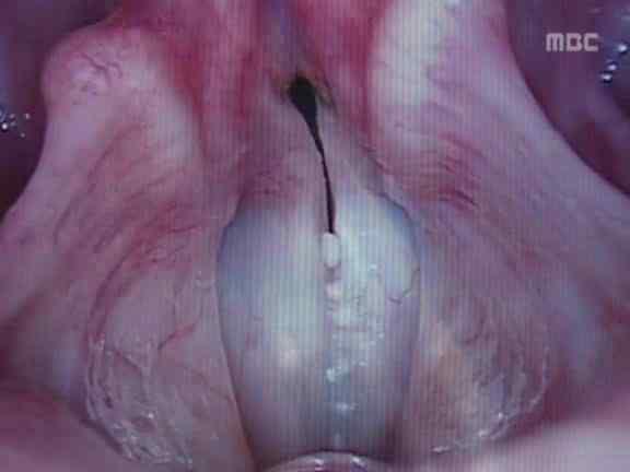 IV. 음성장애를평가하는데사용되는임상기기 이학적인검사 Stroboscopy(fiberscopy), EGG(PGG), Hi-speed