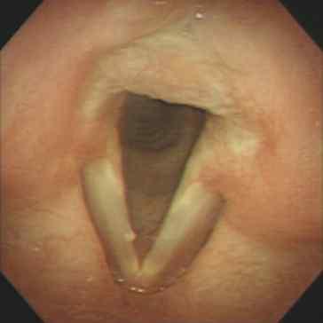bilateral vocal odules