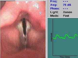 bilateral vocal odules 음향학적인평가 MDVP VRP 공기역학적평가