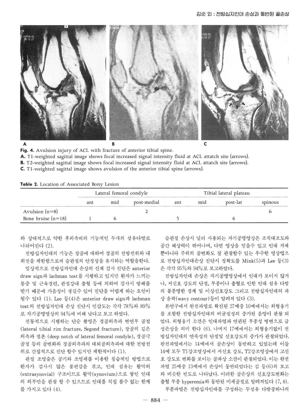 김순오 1: 전밤십자인대손싣괴동반된골손상 A 8 c Fig. 4. Avulsion injury of ACL with fracture of anterior tibial spine A. Tl-weighted 얹s ag 밍따 ltta 려1 ima B.