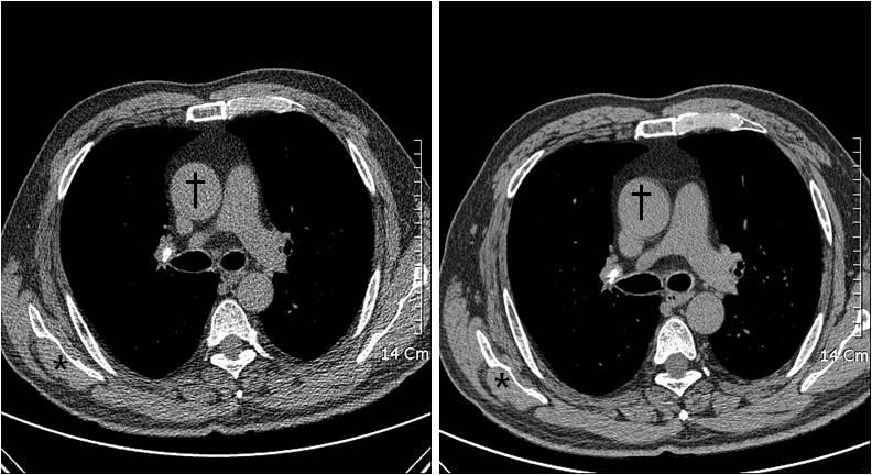 A B Fig. 1. Non-contrast mediastinal images of low-dose (A, 120 kvp, 30 mas, 2-mm thickness) and standard-dose protocol (B, 120 kvp, 180 mas, 1.