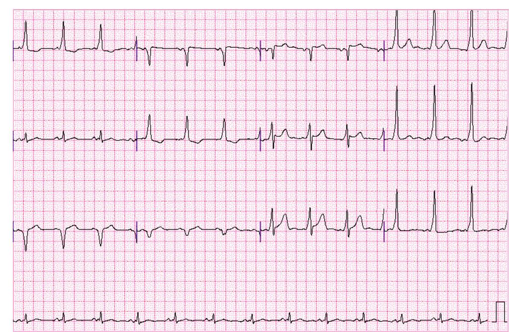 ECG & EP CASES ORIGINAL I avr V1 V4 II avl V2 V5 III avf V3 V6 II Figure 1. 12 lead electrocardiogram on admission revealed ventricular preexcitation. 특성상(전방 지역 근무 군인) 증상 발현시 심전도를 측정하기 재발되지 않았다.