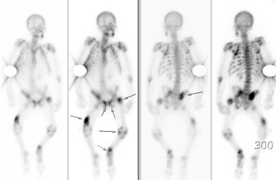 Bone mineral densitometry revealed severely decreased bone mineral density of lumbar (L1~4) vertebrae. D를투여하도록하였다.