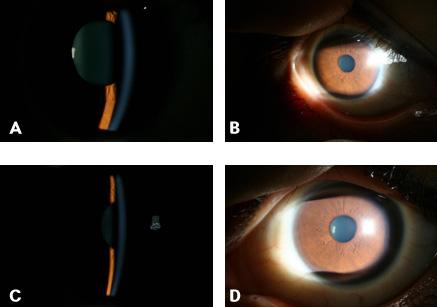presentation. (A) and (B) the right eye; (C) and (D) the left eye. Figure 2.
