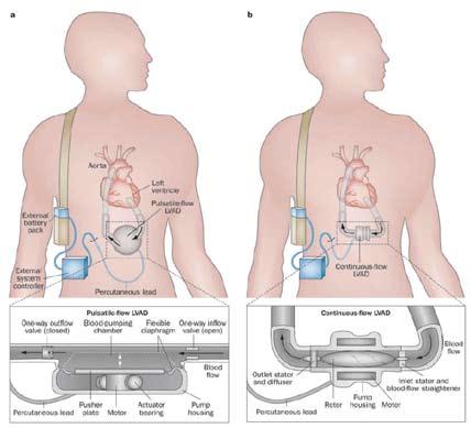 Clinical Training Course 심실보조장치 (Ventricular Assist Device, VAD) 그림 4. A. 박동형 LVAD 의구조, B. 지속성 LVAD 의구조 적절한약물치료와 CRT 등의치료에도불구하고, 많은심부전환자들에서증상이점점악화되어말기심부전 ( 안정시혹은일상적인생활에도심부전증상이나타남 ) 으로진행하게된다.