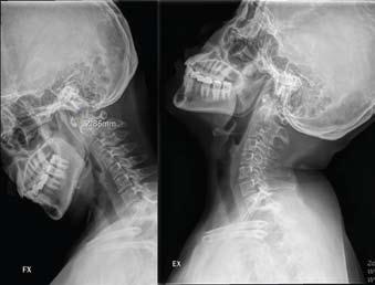 이환자는 6개월전바퀴달린의자에올라가서일하던중의자가미끄러지면서의자에서떨어져머리를부딪힌적이있고, 그후로부터오른쪽뒷머리에두통이발생되었다고한다.