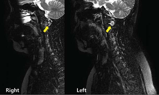번관절면의비대칭이관찰된다. 그림 4. 경추 T1 강조 MRI 영상.