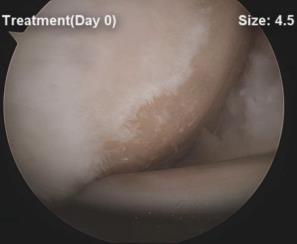 CARTISTEM %(N=43) Microfracture %(N=46) 개선 ( 1 Grade) 98%(42) 72%(33) ICRS Grade 비개선