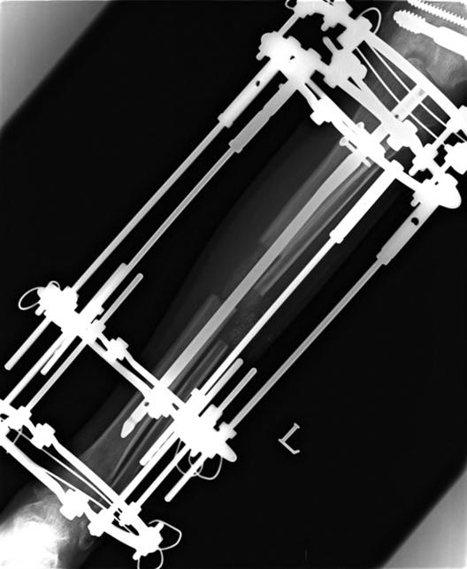 골절치료에서의외고정의치료원칙과최신지견 161 3) 링고정을통한골이동술 (Ring fixator-bone transport) 심한경골골간골절이후발생한급성골소실의치료는복잡한 reconstructive problem 이며많은술식이 bone stock 재건, 골유합, 안정된기능적사지를얻는데에고안되어왔다.