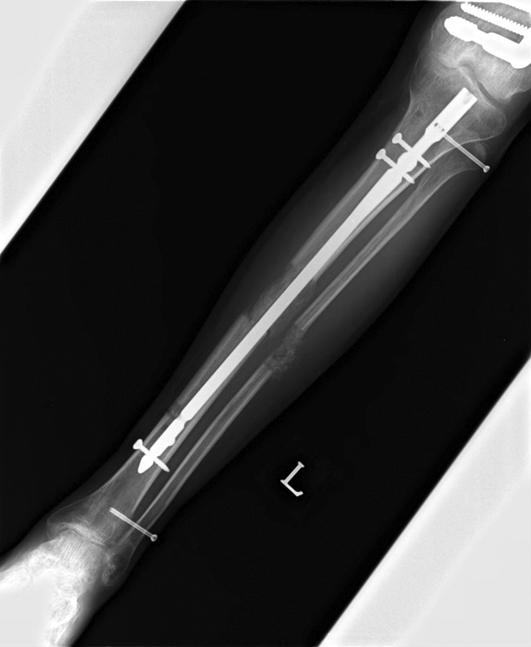 따라서 Fibular bypass, tibial fibular synostosis, 동측 direct fibular transfer, free vascularized fibular transfer 가이러한큰결손부위를재건하기위해사용되어왔다.