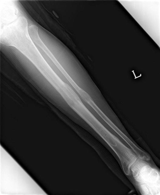 Bone transport 는 bone segment 를이동시키는데에 intercalary sliding mechanism 을이용한 modified monotube monolateral fixator 를이용하여행해질수있으며, ring fixator 또한성공적인 intercalary bone transport 에사용될수있다.