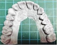 대조군원본모형스캔이미지와 3D 프린팅된출력물스캔이미지의중첩에의한음영차이를나타내는색지도의대표적인예가 Figure 3에나타나있다. 색지도에서녹색은원본과출력물이거의차이가없음을나타내는것이고, 파란색은출력물이원본보다함몰된것이고, 빨간색은출력물이원본보다돌출된것이다. Figure 3. Color map showing volumetric difference between the scanned images of original model and 3D printed model.