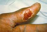 역학및감염병관리 2 임상적특성 피부궤양성림프절 (Ulceroglandular) 형야토병 - 야토병의 75 85% 차지 - 감염된동물과접촉및진드기 ( 또는등에 )