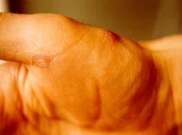 림프절 (Glandular) 형야토병 - 발열, 국소적인림프절형증있으나, 피부궤양은없음 - 야토균이피부병변없이또는혈액을통해림프절로이동시발생함 - 일반적으로야토균에감염된진드기 ( 또는등에 )