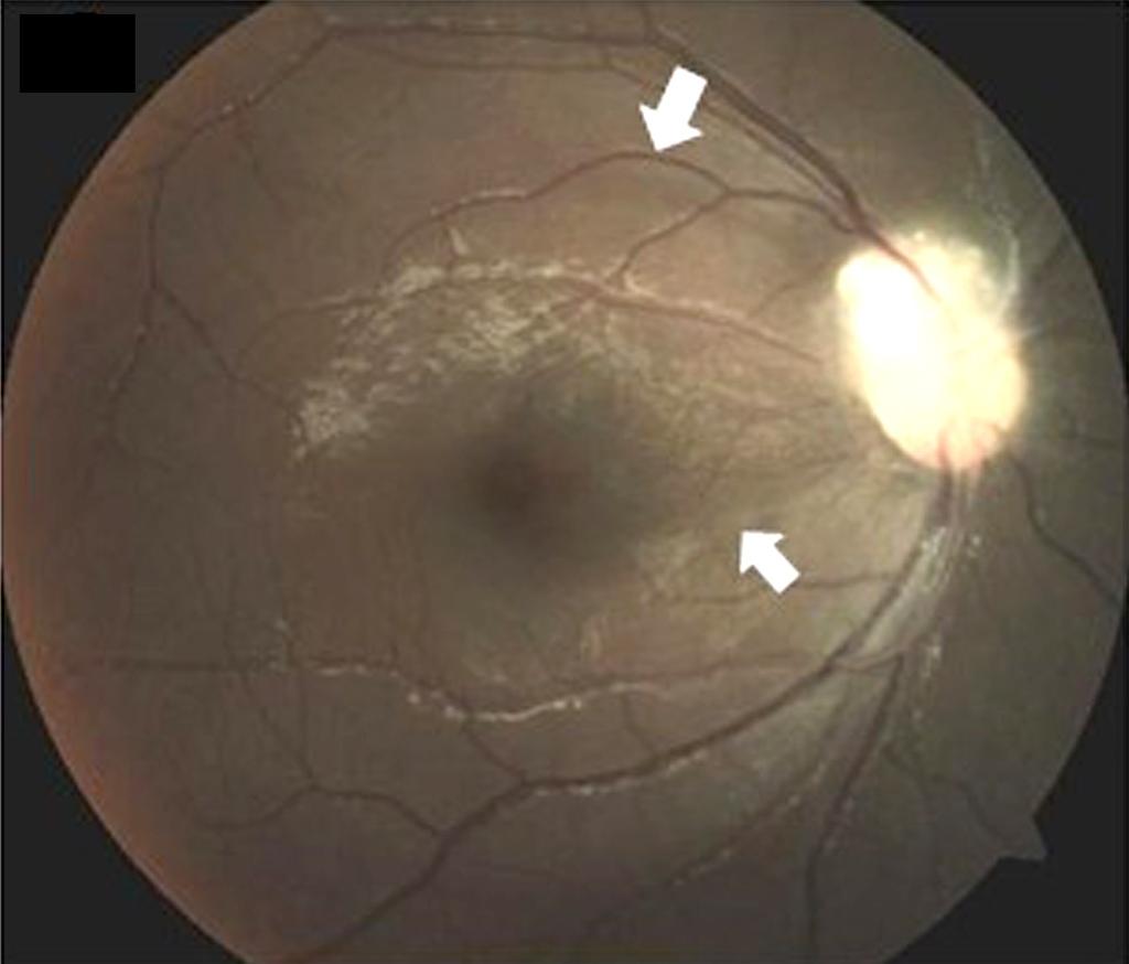 diameter-sized mulberry-like protruding tumor above the right optic