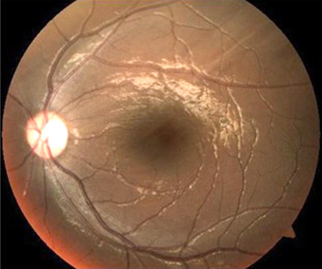 (B) One year and 6 months after the first visit, fundus photograph