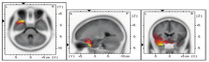 EEG(ElectroEncephaloGraphy): 뇌의활동으로발생하는전류인뇌파의주파수와진폭을그린뇌전도를분석하여뇌의상태를알아보는방법 1년간디지털교과서를사용한학생을면담하여정신적건강문제가있는지파악한결과에서는긍정적경험이많았으나부정적경험도다소있었습니다. 부정적경험의이유는대부분학습용단말기의오작동등의기술적인문제였습니다.