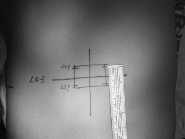 78 민상혁ㆍ황성수 Fig. 1. The clinical photograph showing paramedian skin incision 2.5 cm from midline before surgery. Fig. 3.