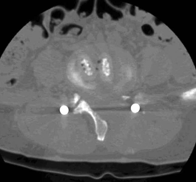 추궁하감압술에의한최소침습적일측성경추간공요추추체간유합술 79 Fig. 4. (A) Preoperative CT film of a 50-year-old female patient.