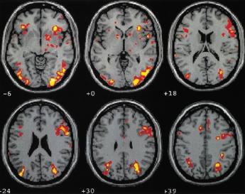 Fig. 1. BOLD-MR images from 6 contiguous axial slices: (A) implicit vs.