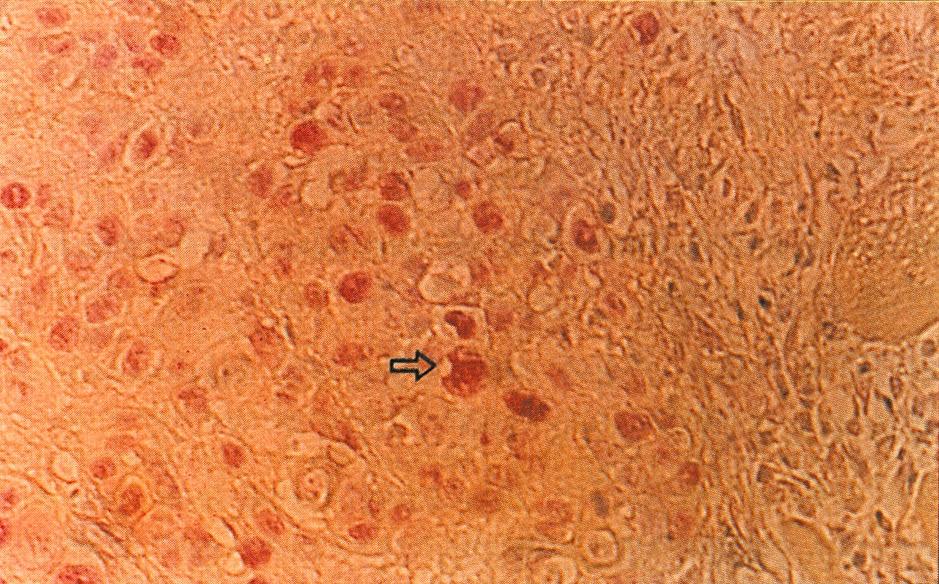 Immunohistochemical staining of proliferating cell nuclear antigen with APAAP (alkaline phosphatase anti-alkaline phosphatase) method in sinonasal inverted papilloma tissue.