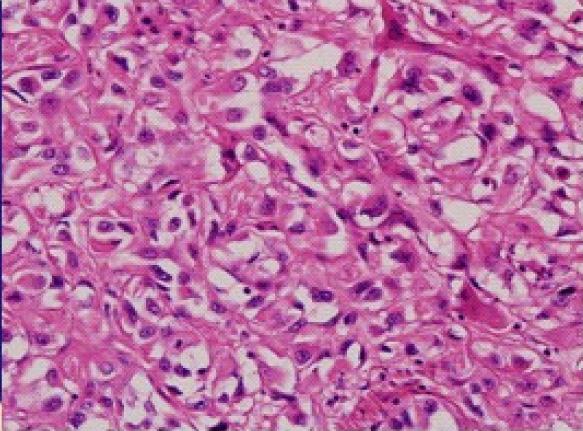 (B) Tumor cells were epithelioid, dendritic, or intermediate, and those with intracytoplasmic lumina appeared as signet ring cell-like structures (H&E stain, 400).