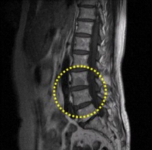 Lumbar-spine magnetic resonance imaging exhibited a round low-density lesion about 1.8 cm in diameter on T1- weighted images (B-1) and T2-weighted images (B-2) in the L3 body. A similar 1.