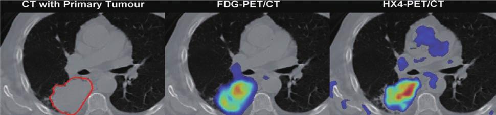 레디오믹 (Radiomic) 분석과암의료영상 < 그림 1> 폐암에대한 CT 영상과 PET 영상. 왼쪽빨간색테두리안쪽부분이 CT 영상에서암을표시한부분이며가운데와오른쪽영상은 CT 영상 ( 흑백 ) 에 PET 영상 ( 컬러 ) 을정합한그림이다 ( 왼쪽 : CT 영상 ; 중앙 : FDG-PET 영상 ; 오른쪽 : HX4-PET 영상 ). 인방법으로분류된다.