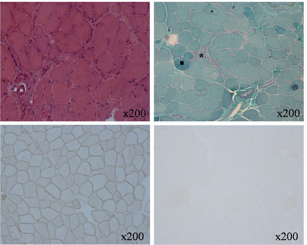 HJ Park, et al. Diagnosis and Therapy of Limb Girdle Muscular Dystrophy 된다.