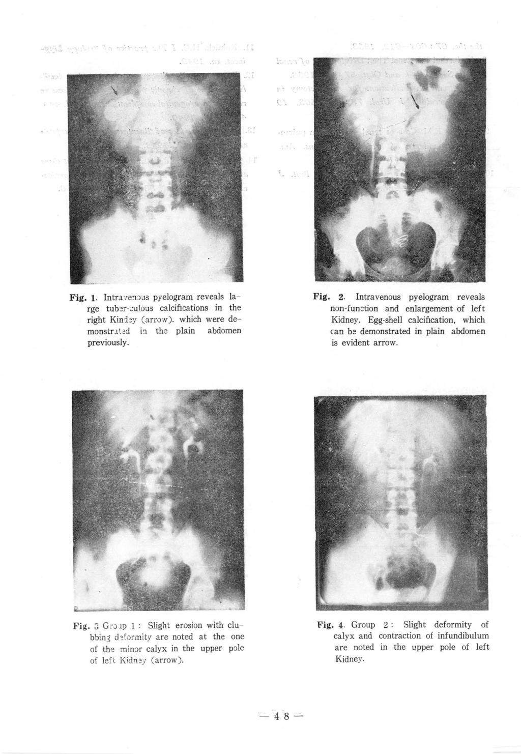 1 f Fig. 1. Intr;neélJUS pyelogram reveals large tub ~r culous calcincations in the right Kin'Ì'!y (arr0w). which were de monstn t 년 i~ the plain abdomen previously. Fig. 2.