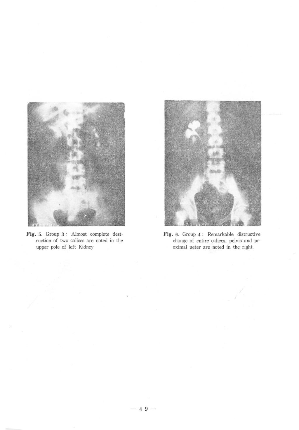 Fig. 5. Group 3: Almost complete destruction of two calices are noted in the upper pole of left Kidney Fig. 6.