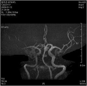 TOF(TopOfFlight)&MRAngiography Fig.4.