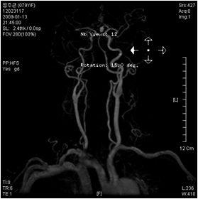 DOPPLER US Mildatherosclerosis,leftupperextremity.